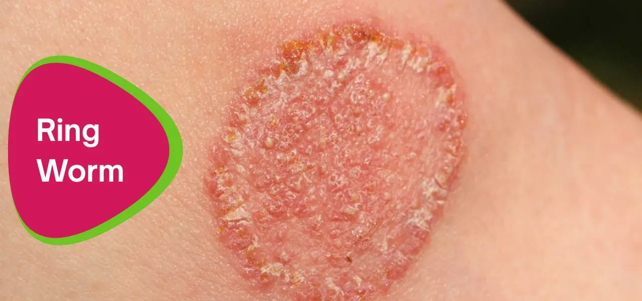 An image of a ringworm infection on the skin