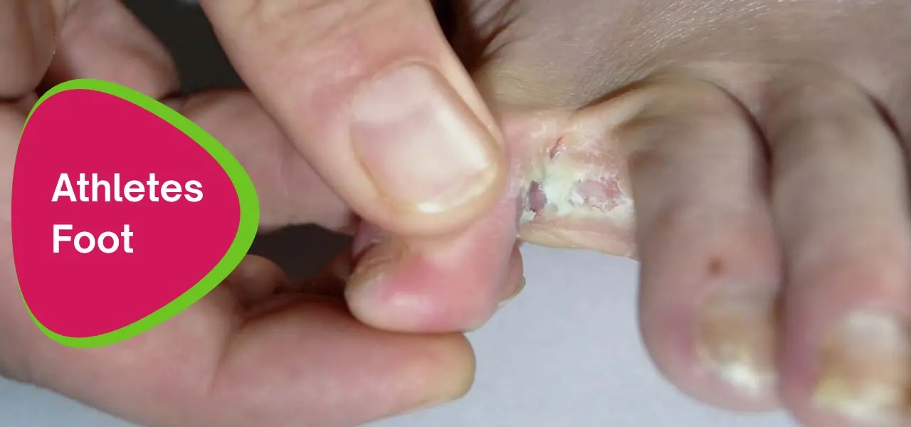 An image of athletes foot afflicted patient