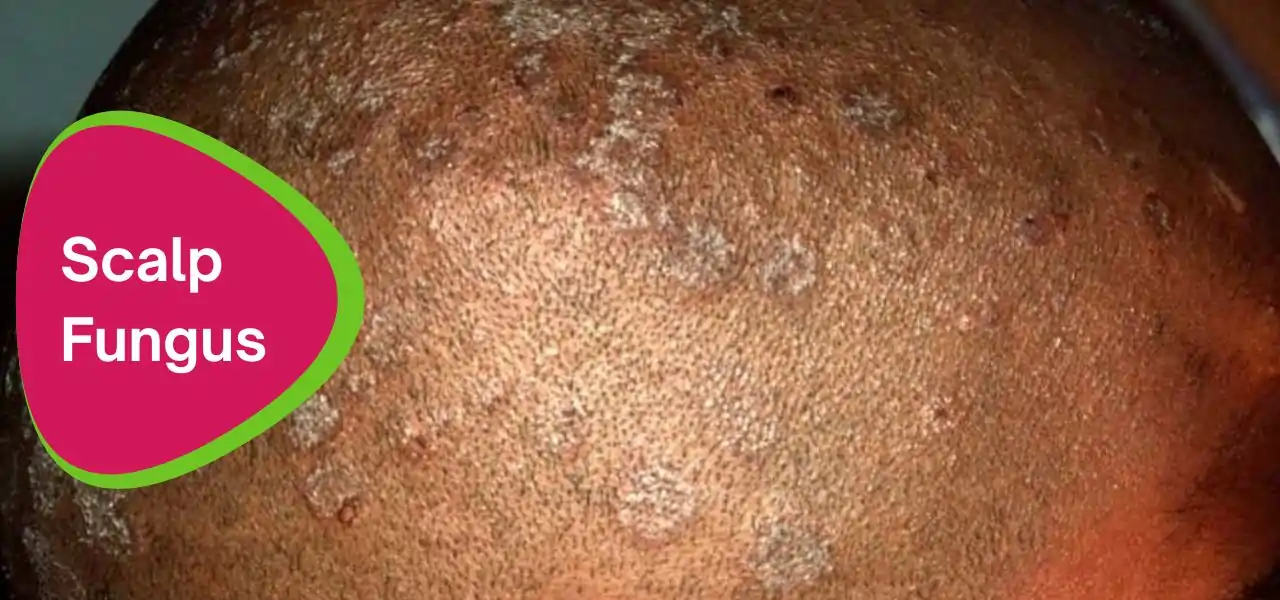 an image of a patient with scalp fungal infection